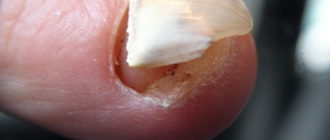 Надорвал ноготь