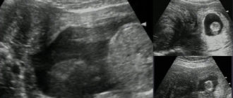Миома или беременность