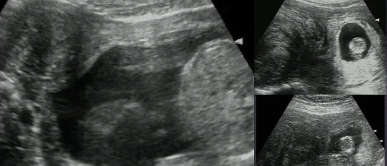 Миома или беременность