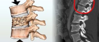 Давность перелома позвонка