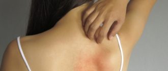 Воспаление на коже. Зуд