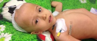 Эпилепсия, дцп, тетрапарез, псевдобульбарный синдром