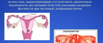 Внематочная беременность или киста