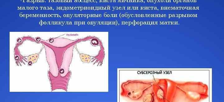 Внематочная беременность или киста
