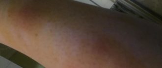 Чешутся ноги, появляются синяки