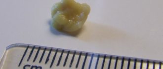 Вышел камень изо рта