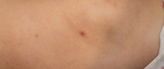 Что за высыпание и на что это похоже?