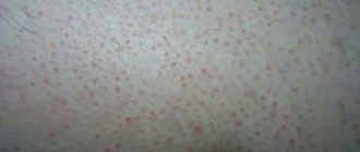 Чёрный прыщ на ляжке