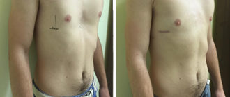 Деформация грудной клетки у ребенка после операци