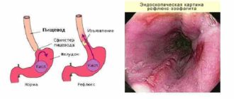 Дистальный катаральный рефлюкс эзофагит и всд