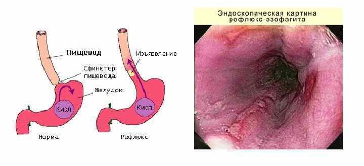 Дистальный катаральный рефлюкс эзофагит и всд