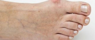 Нарост на кости