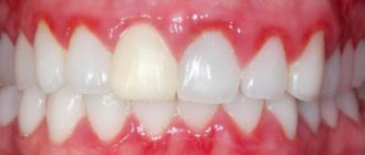 Высокая температура, гингивит