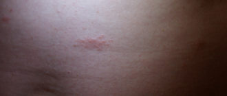 Водянистые высыпания на животе