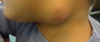 Восполение лимфоузла. Беременность 14 недель