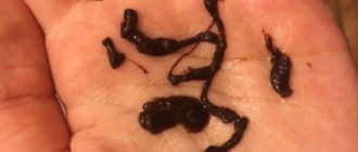 Выделение, похожее на червя, во время первого дня месячных