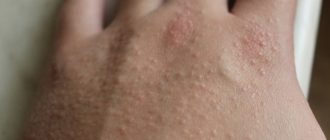 Висипь на руках