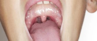 Что со мной? Желтый язык, сильно болит горло.