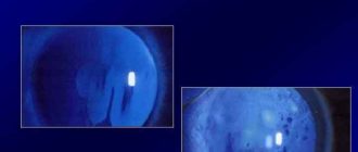 Диагноз: Разрыв слёзной плёнки