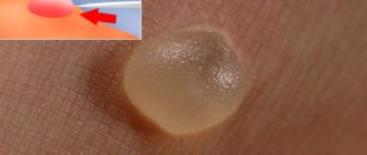 Волдырь похожий на мозоль