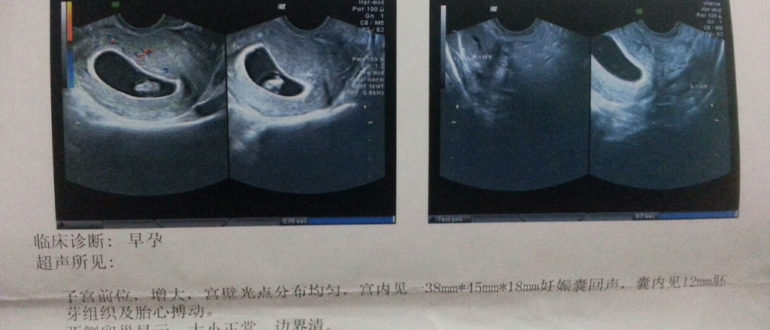 Мягкая матка после фарм аборта