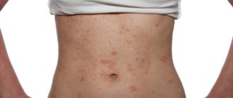 Менструальный дерматоз