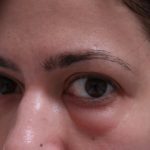 Диффузные изменения поджелудочной железы по типу жировой инфильтрации