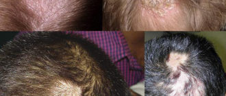 Можно ли мыться со стригущ. Лишаем