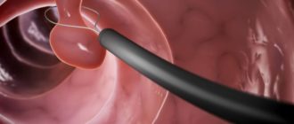 Длительность кровотечения после удаления полипа уретры