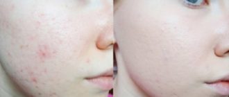 Можно ли пользоваться базироном постоянно?