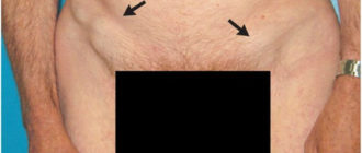 Воспаление лимфоузла в паховой области