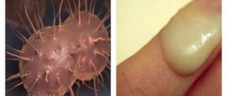 Воспаление основания пениса