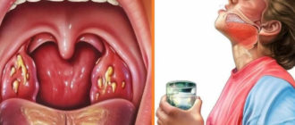 Дикая боль в гландах, но нет ни температуры, ни озноба