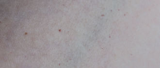 Микроскопические точки на теле