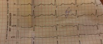ЭКГ расшифровка пожалуйста