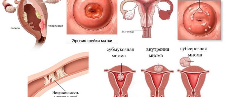 Эндоцервицит и миома