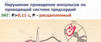 Нарушение внутрипредсердной проводимости