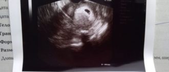 УЗИ на 4-5 неделе