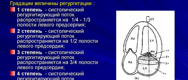 Митральная и трикуспидальная регургитация