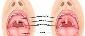 Долго не проходит краснота в горле, дужки
