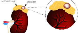 Что делать если обнаружили аденому надпочечника