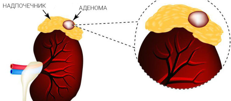 Что делать если обнаружили аденому надпочечника