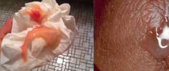 Выделение сукровицы