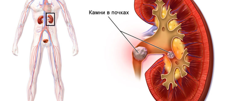 Воздух попал в почки