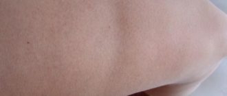 Вмятина на ноге