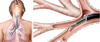 Что информативнее, пункционная биопсия легких или бронхоскопия