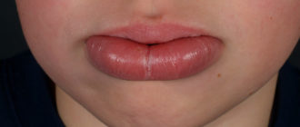 Воспаление на нижней губе