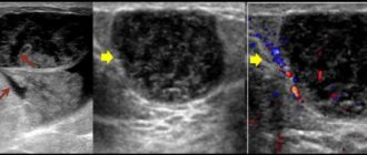 Может ли УЗИ не увидеть фиброаденому?