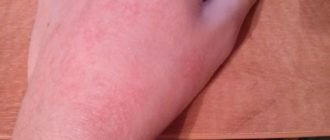 Кожа чешется, краснеет и взбухает и в течении часа проходит