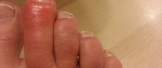Воспаление и отек между пальцами